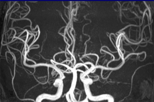 医療法人聖比留会 セントヒル病院 セムイPET・画像診断センター脳血管の映像