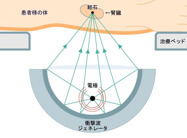 厚南セントヒル病院の腎・尿管 体外衝撃波結石破砕装置説明図