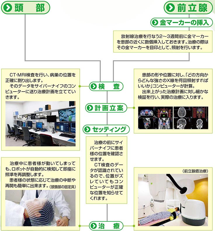 厚南セントヒル病院のサイバーナイフって何1