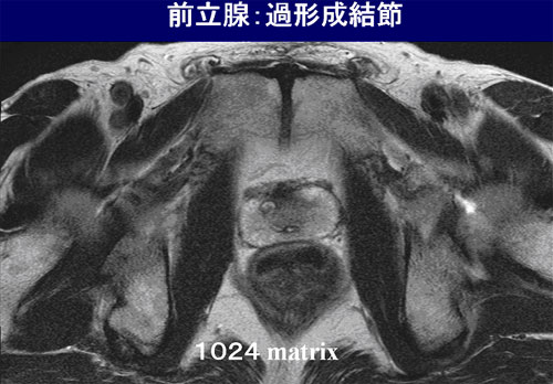 医療法人聖比留会 セントヒル病院 セムイPET・画像診断センター前立腺の映像