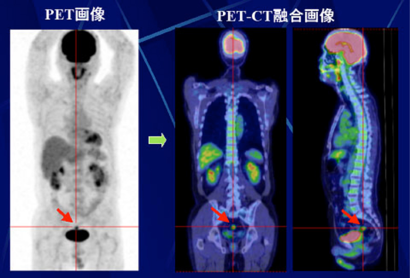 実践! PET-CT診断