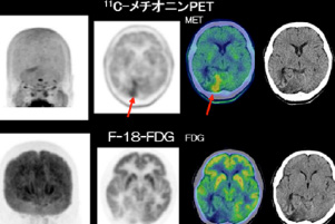 医療法人 聖比留会　セントヒル 病院 セムイPET・画像診断センターPET/CT装置について3