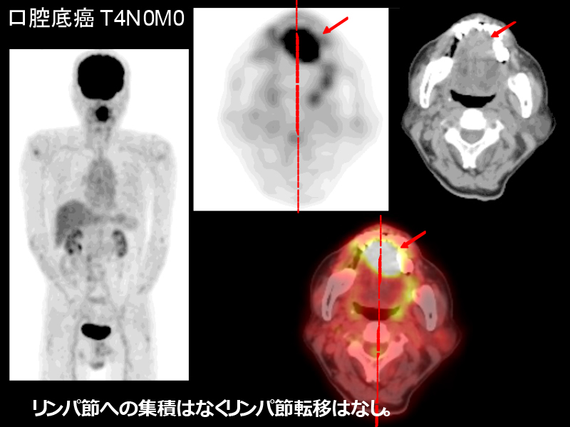 鎖骨 上 リンパ 節