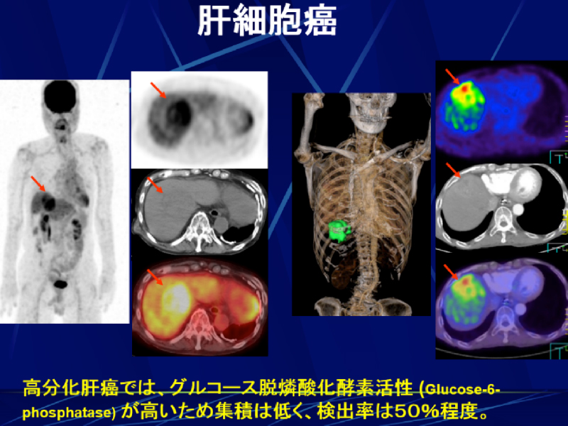 Pet検査の得意な病気 セムイpet 画像診断センター