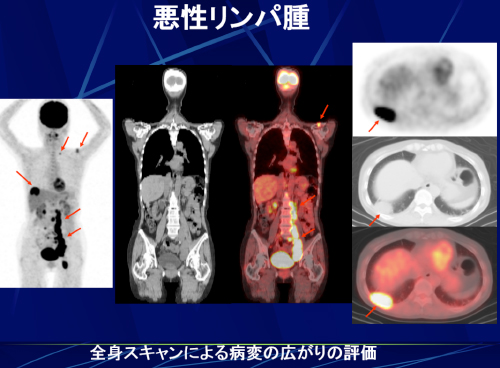 PET検査の得意な病気 | セムイPET・画像診断センター