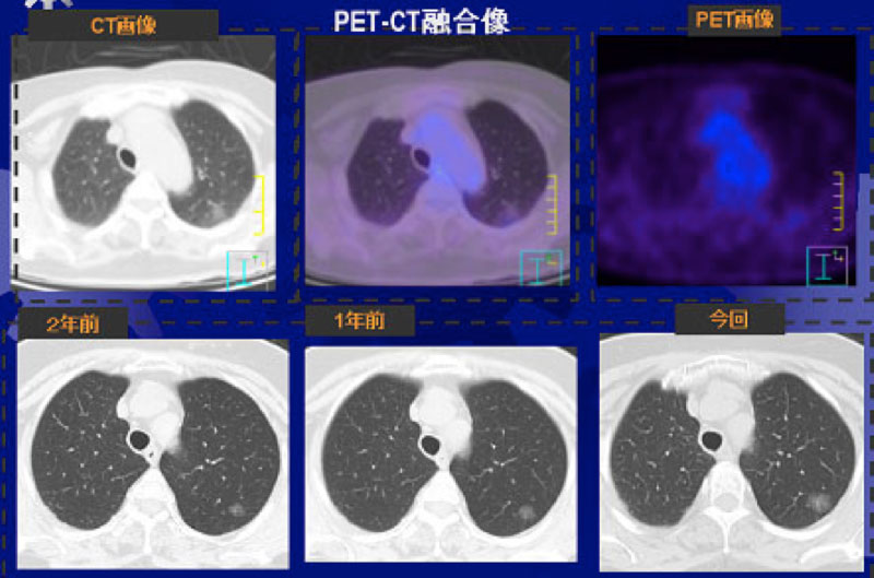PET検査の得意な病気 | セムイPET・画像診断センター